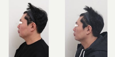 35-44 year old man treated with AccuLift, Liposuction, Laser Liposuction - 39 Years old male patient Chief Complain: Bulky cheeks, overal puffiness and the lack of masculine contours, looking gloomy and more older then his real age. Puffy, tired undereye areaTreatment Plan: undereye fat reposition, face liposuction (double chin, cheek bone, cheeks, near mouth)Outcome: pure fat liposuctioned : double chin (-30cc), middle face line (- 50cc) fresher and more youthful face shape, reduce exessive fat, more refined appearance and masculine shaped jaw line.