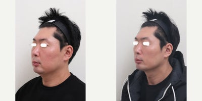 35-44 year old man treated with AccuLift, Liposuction, Laser Liposuction - 39 Years old male patient Chief Complain: Bulky cheeks, overal puffiness and the lack of masculine contours, looking gloomy and more older then his real age. Puffy, tired undereye areaTreatment Plan: undereye fat reposition, face liposuction (double chin, cheek bone, cheeks, near mouth)Outcome: pure fat liposuctioned : double chin (-30cc), middle face line (- 50cc) fresher and more youthful face shape, reduce exessive fat, more refined appearance and masculine shaped jaw line.