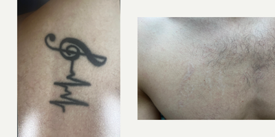 25-34 year old man treated with Tattoo Removal - 25-34 year old man treated with Tattoo Removal