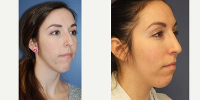 25-34 year old woman treated with Rhinoplasty - Patient underwent a rhinoplasty procedure 10 months ago.
