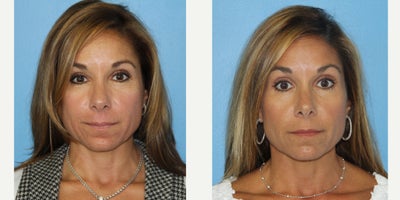 46 year old woman treated with Exilis - 46 year old woman after three Exilis treatments to the face to tighten skin. Notice the tighter lower jawline.