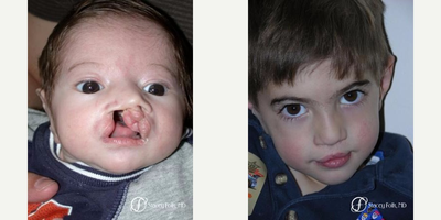 17 or under year old man treated with Cleft Lip And Palate Repair - Cleft lip and palate repair