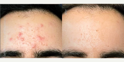 Woman treated with AviClear, Skin Rejuvenation - Achieve clear, glowing skin with our bespoke acne treatments!Try AviClear combined with custom laser sessions and monthly Diamond Glow Facials with Chloe & Dr. Arash Moradzadeh