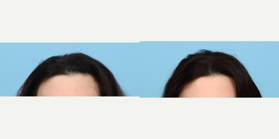 35-44 year old woman treated with Hair Loss Treatment, PRP Injections, PRP for Hair Loss - To add overall density due to thinning hair, this 37-year-old patient did 3 sessions of PRP. Her results are shown 3 months after her last treatment.