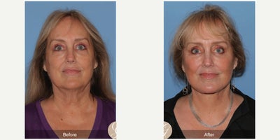 66 year old woman treated with Deep Plane Facelift, Neck Lift, Eyelid Surgery, CO2 Laser, MACS Facelift - 66 year old woman treated with Deep Plane Face and Neck Lift, Lower Blepharoplasty, CO2 Laser ofFace, MAC