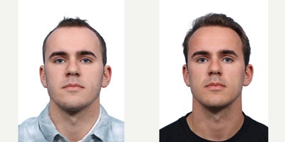 18-24 year old man treated with FUE Hair Transplant, PRP for Hair Loss - Goals: Add more volume and density and restore the front hairlineProcedure: FUE hair transplant and PRP Hair TherapyGrafts: 2500 grafts, zones 1 and 2Photo Timeline: 6 months post-op