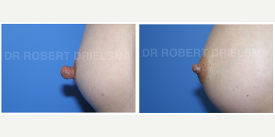 40 year old woman treated with Nipple Surgery - Enlarged nipples causing cracking and fissuring, discomfort and bleeding. Symptoms and problems cured as well as appearance corrected using a nipple reduction procedure.