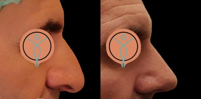 35-44 year old man treated with Closed Rhinoplasty - Closed Rhinoplasty