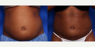 25-34 year old woman treated with CoolSculpting - Age: 25-34             Applicator: CoolCore      Treatment Package: 4 cycles       Location: Abdomen

Photos: 3 months post treatment