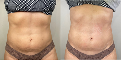 55-64 year old woman treated with truSculpt flex - TruSculpt Flex - the fastest muscle sculpting and body contouring device on the market! Personalize your treatments to your exact body goals and needs to ensure your ideal results! Can be done as often as twice a week for optimal results.Treatable Areas:- abdomen- obliques- butt- legs