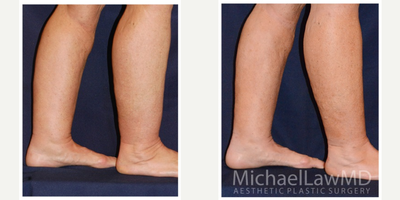 45-54 year old woman treated with Calf Reduction - Lower leg liposcution