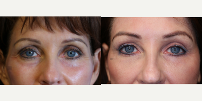 Fat transfer and laser resurfacing. - non-surgical eye rejuvenation with fat transfer and laser resurfacing.