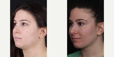 25-34 year old woman treated with Neck Lift, Chin Liposuction - Love seeing these great results after a deep neck lift and liposuction below the jawline! For this result, we combined liposuction laterally under the jawline, removed the deep fatty tissues under the floor of the mouth, and contoured and tightened the central muscles of the neck to get a sharper neck angle and more defined jawline. As we know, it's not the modalities we use, it's the RESULT that's important along with reducing recovery time as much as feasible! Thank you to this beautiful patient for letting us share these photos.