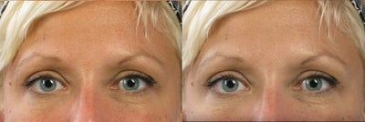 Botox for frown lines and crow's feet - This before and after demonstrates how botulinum toxin reduces glabellar wrinkles (frown lines) and creates improved brow arch. The forehead was not treated, but these lines are also improved by relaxing the brow depressor muscles. In a young patient, Botox can act to prevent the appearance of deep lines in the future.