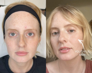 Woman treated with Ellacor - Woman treated with Ellacor