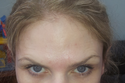 Forehead botox caused eye wrinkles, will they go away and can they be ...