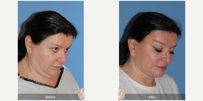 58 year old woman treated with Deep Plane Facelift, Neck Lift, Facelift, Brow Lift, MACS Facelift - 58 year old woman treated with Deep Plane Face and Neck Lift, Endoscopic Temporal Brow Lift, MAC