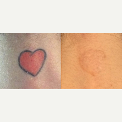 45-54 year old woman treated with Enlighten - Removed red and black ink in just 2 treatments from back of neck.