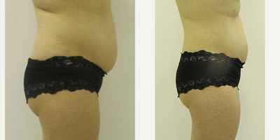45-54 year old woman treated with Liposonix - 45-54 year old woman treated with Liposonix