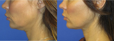 45-54 year old woman treated with Profound RF - 47 year old female with laxity to her lower face and neck. She had the Profound RF treatment to her lower face and upper neck. Note, the improved contour of her neck and jawline. These are early results and will continue to get more improvement over the next several months.