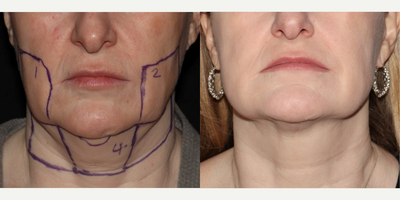 45-54 year old woman treated with PrecisionTx, Sofwave - This 54 year old female underwent a combination of Precision Tx (Submental liposuction plus laser jawline tightening) and Sofwave micro-focused ultrasound treatment of the same regions shown, to provide additional dermal tightening. This is her result at 1 month. She can expect continued improvement over the course of 5 more months as the area continues to remodel.