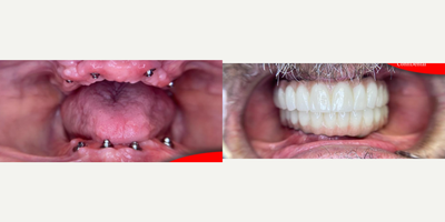 35-44 year old woman treated with Dental Bridge, Dental Bonding, Dental Crown - The All-On-Four Technique, which should be planned individually for the purpose of creating aesthetic smiles and avoiding chewing and speech disorders of the patients, consists of surgical and dental prosthesis procedures. A total of 4 dental implants were placed in the anterior and posterior parts of the jaw on the same day. After the procedure is performed under local anesthesia, a temporary prosthesis is attached to the patient. Approximately 2-3 months after the procedure, temporary prostheses are replaced with fixed prostheses.