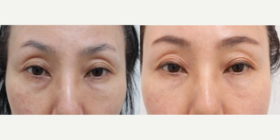 45-54 year old woman treated with Silhouette Soft, AccuLift, Nonsurgical Facelift - 52 Years old female patient Chief Complains: sagging cheeks, under eye bags, uneven face line Treatment plan: - perioral mounds liposuction- silhouette soft thread lift (for middle face area)- full face fat graft- eyelid nano-fat graft- transconjunctival fat repositioning T/C Effect : - smooth face line (temple & cheek hollows was fixed) - face volume restore (forehead, upper cheeks) > more youthful look - flat and smooth eye area- slight lifting effect (lower and middle face part)
