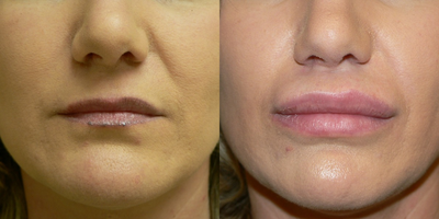 35-44 year old woman treated with Lip Augmentation using Alloderm - She's still a little swollen and processing the Alloderm at this point.