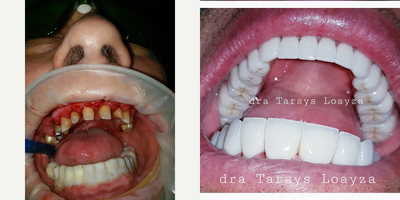 55-64 year old man treated with BriteSmile - Implants crowns zirconi