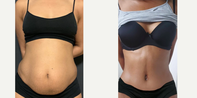 35-44 year old woman treated with Mommy Makeover (Tummy Tuck and silicone Breast Augmentation). - Note the: - Athletic shape. - Natural centered belly button with VERY low incision. - Hourglass shape