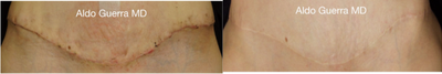 45-54 year old woman treated with Embrace Scar Therapy - Close up photos of a tummy tuck incision treated with embrace Active Scar Defense before and after 14 months post op.