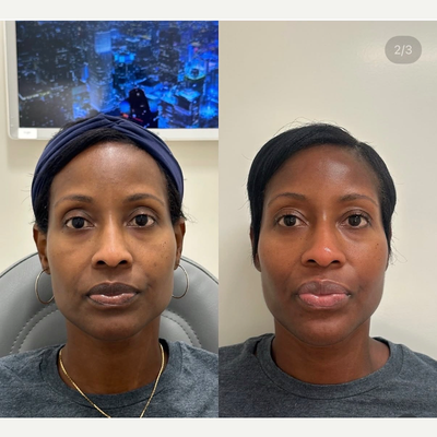 45-54 year old woman treated with Chemical Peel, Sculptra, Restylane - This was the result of a multi-modal approach for a lovely patient of ours, achieved with volume restoration with filler and Sculptra and skin smoothing and brightening achieved with an upgraded medical grade skincare routine as well as a series of chemical peels.