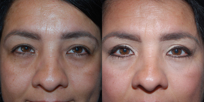 Brow Lift - Brow Lift