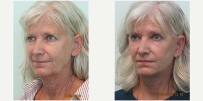 65-74 year old woman treated with Facelift, Browlift, and Upper Blepharoplasty - This active senior presented with the desire for overall facial rejuvenation without the need for undergoing general anesthesia. She did not like the heaviness of her upper eyelids nor the overall droopiness of her lower face and neck. After thorough evaluation, we decided together to perform a lower facelift, necklift, upper blepharoplasty, and browlift in one treatment session. Under local anesthesia (with oral sedation with valium) we performed all four treatments in under four hours time. Her results demonstrate significant opening of her upper eyes and brow, along with marked improvement of her jawline contour and neck heaviness. She was able to return to her full normal activities (including exercise) 14 days after procedure.