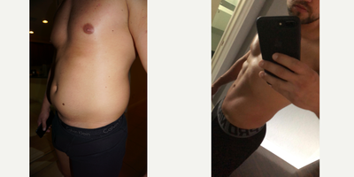 35-44 year old man treated with Abdominal Etching - 35 year old male. Treated with hi-definition vaser lipo, and abdominal etching.