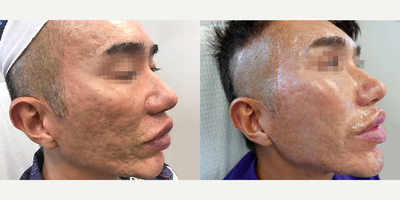 Man treated with Subcision - Man treated with Subcision.