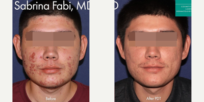 Man treated with Photodynamic Therapy - Man treated with Photodynamic Therapy