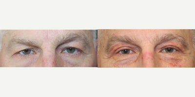 55-64 year old man treated with BUL Blepharoplasty (Post-Operative Week 1) - BUL Blepharoplasty (Post-Operative Week 1)