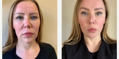 Woman treated with Emface - Woman treated with Emface