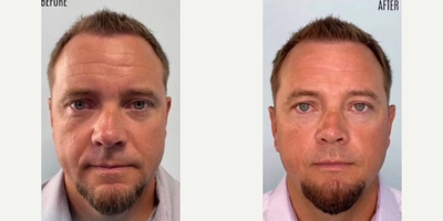 Man treated with Emface - Man treated with Emface