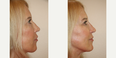 45-54 year old woman treated with Rhinoplasty - This is a liquid rhinoplasty.  This patient desired to even out the dorsum of her nose. She does not want actual surgery. Instead, we chose to use a hyaluronic acid filler applied to the dorsum of her nose and to the nasal tip. The photos shown are before and immediately after the injection. Specifically, I used Belotero, however many dermal filler options exist to accomplish this goal.