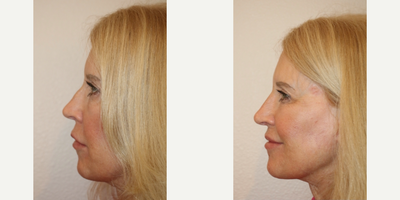 45-54 year old woman treated with Rhinoplasty - This is a liquid rhinoplasty.  This patient desired to even out the dorsum of her nose. She does not want actual surgery. Instead, we chose to use a hyaluronic acid filler applied to the dorsum of her nose and to the nasal tip. The photos shown are before and immediately after the injection. Specifically, I used Belotero, however many dermal filler options exist to accomplish this goal.