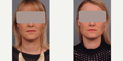 Woman treated with Chin Liposuction - Woman treated with Chin/Neck Liposuction to define jawline and side profile. Pre-op, patient complained of fullness in her double chin region. She is shown before and 3 months post op.