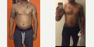 34 year old man treated with Male Liposuction and  Male Breasts Reduction 01M PO - 34 year old man with several abdominal lipodystrophy (excess fat tissue) and excess mammary tissue (Gynocomastia) - treated with Male Liposuction and Male Brest Reduction (with semilunar or mid peri areolar, unnoticeable scar).