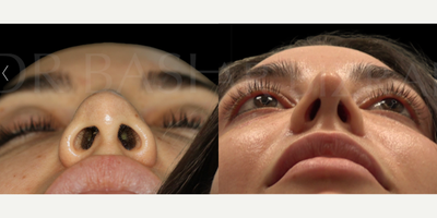 Woman treated with Sinus Surgery - Blocked Nose