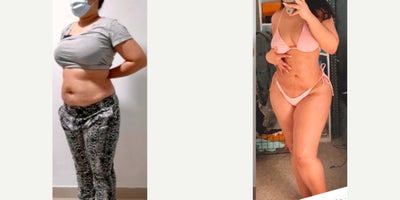 25-34 year old woman treated with Liposuction, BodyTite, Brazilian Butt Lift - 25-34 year old woman treated with Liposuction, BodyTite, Brazilian Butt Lift