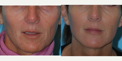 45-54 year old woman treated with Thermage, BBL and Juvederm to the lips and perioral region - Over the course of 9 months this woman underwent two BBL treatments, Thermage and Juvederm to the lips and perioral wrinkles.  Her skin is smoother and tighter.