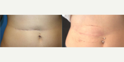 25-34 year old woman treated with Scar Removal - Abdominal appendectomy scar treated with scar revision and fat grafting and Embrace dressing