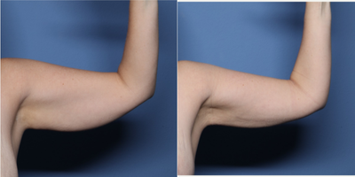 35-44 year old woman treated with BodyTite - 38 year old shown 3 months after BodyTite liposuction to her arms (550 cc removed).