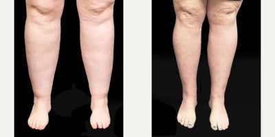 35-44 year old woman treated with Lipedema Surgery, Tumescent Liposuction, Liposuction - Ive never had ankles before!Dr. Smarts Stage 2 patient is a resilient stay-at-home mom of 5. Despite losing over 100 lbs through keto and exercise with hard work and incredible determination, she struggled to see any changes in her lower extremities.Just a couple of months after Lipedema Reduction Surgery, the results are remarkable! Her leg cuffing has significantly reduced, and shes seeing her ankles for the very first time.And the best part is that these results will only improve as swelling subsides.
